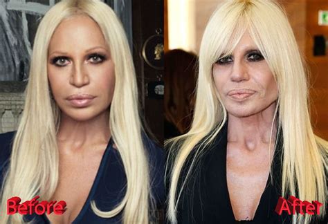 donatella versace rehab|donatella versace facelift.